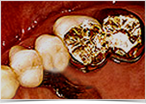 dentallabor-konuskronen-goettingen
