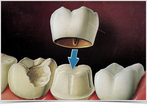 dentallabor-metallkeramik-goettingen