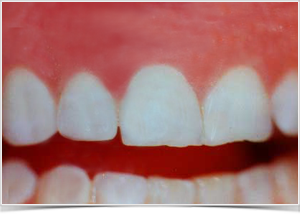 parodontose-zahnfleisch-goettingen